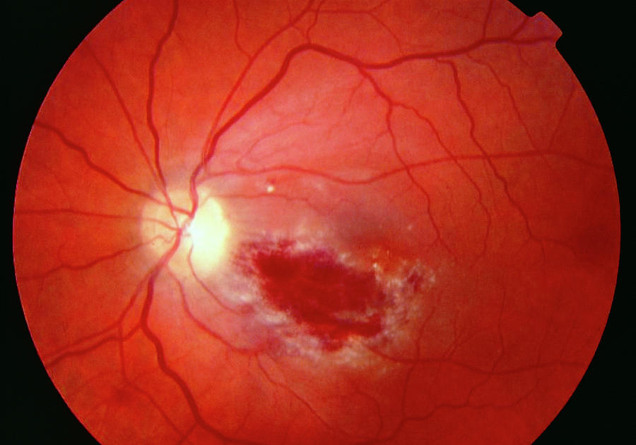 Benign Eye Tumour #1 Photograph by Sue Ford/science Photo Library