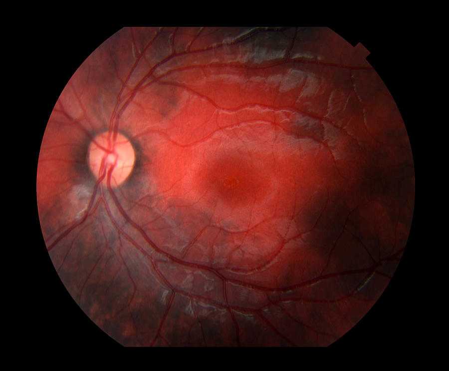 Bilateral Melanosis Of Eye #1 Photograph by Paul Whitten