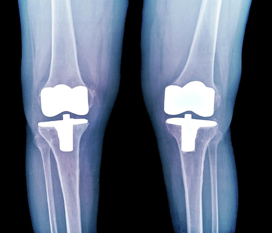 Bilateral Total Knee Replacement Photograph By Zephyr Science Photo Library Fine Art America