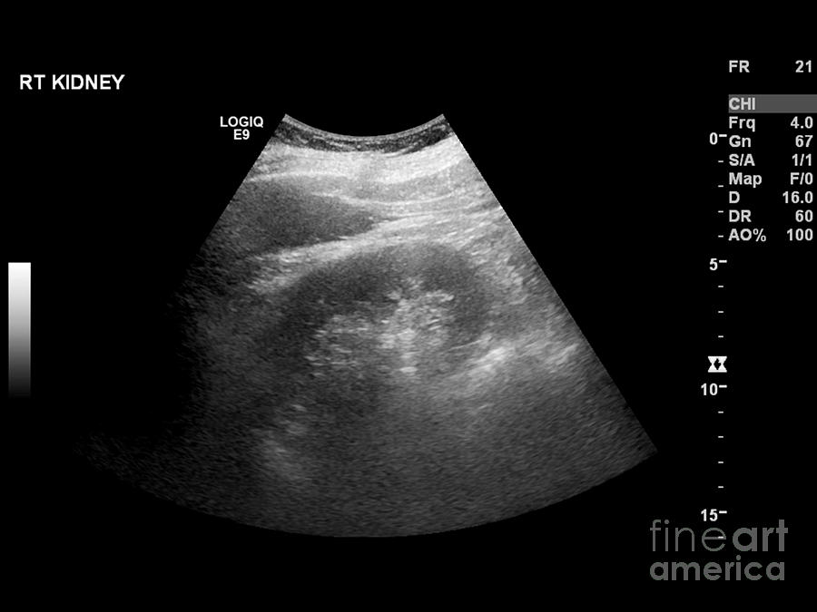 Bladder Mass, Ultrasound Scan Photograph by Science Photo Library ...