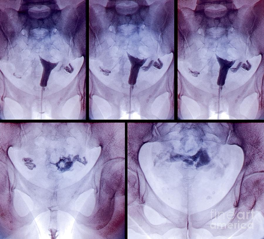 Disorder Photograph - Blocked Fallopian Tubes, X-rays #1 by Zephyr