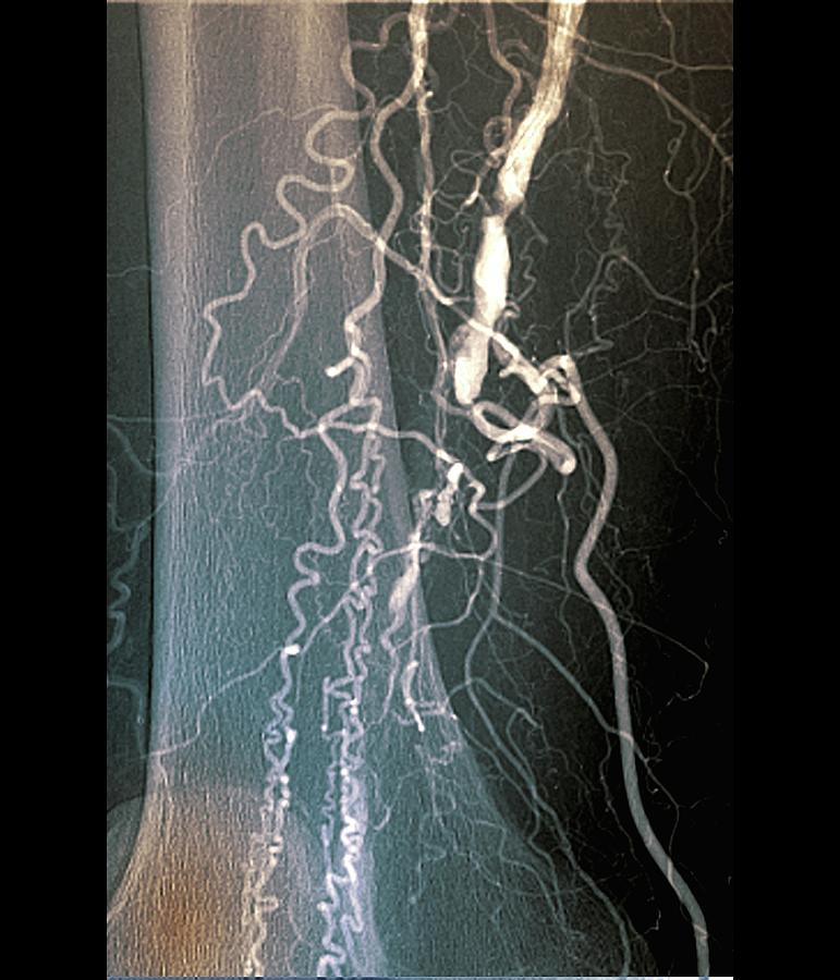 Blocked Femoral Artery #1 Photograph by Zephyr/science Photo Library