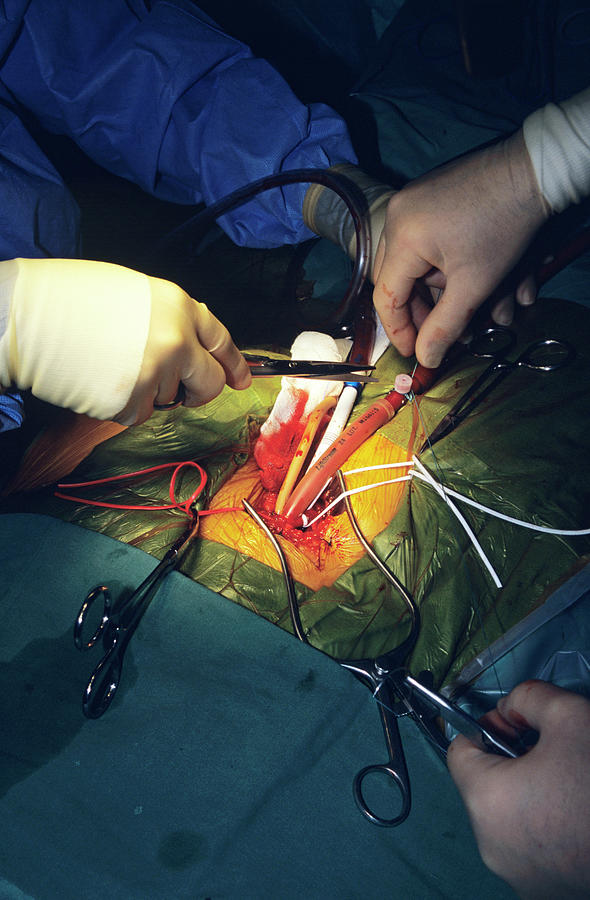 Blood Bypass Tubes #1 Photograph by Science Photo Library Blood Bypass Tubes #1 Photograph by Science Photo Library