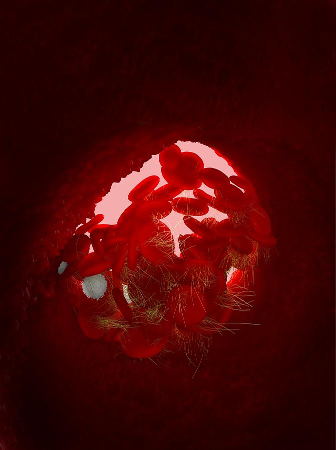 Red Blood Cell Photograph - Blood clot, artwork #1 by Science Photo Library