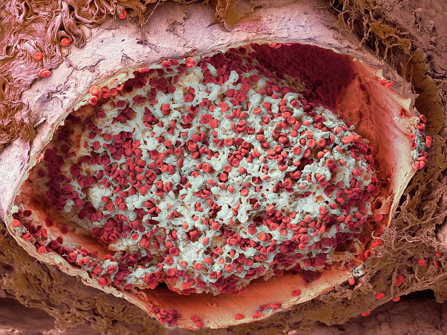 Blood Clot In The Lung Photograph by Microscopy Core Facility, Vib Gent