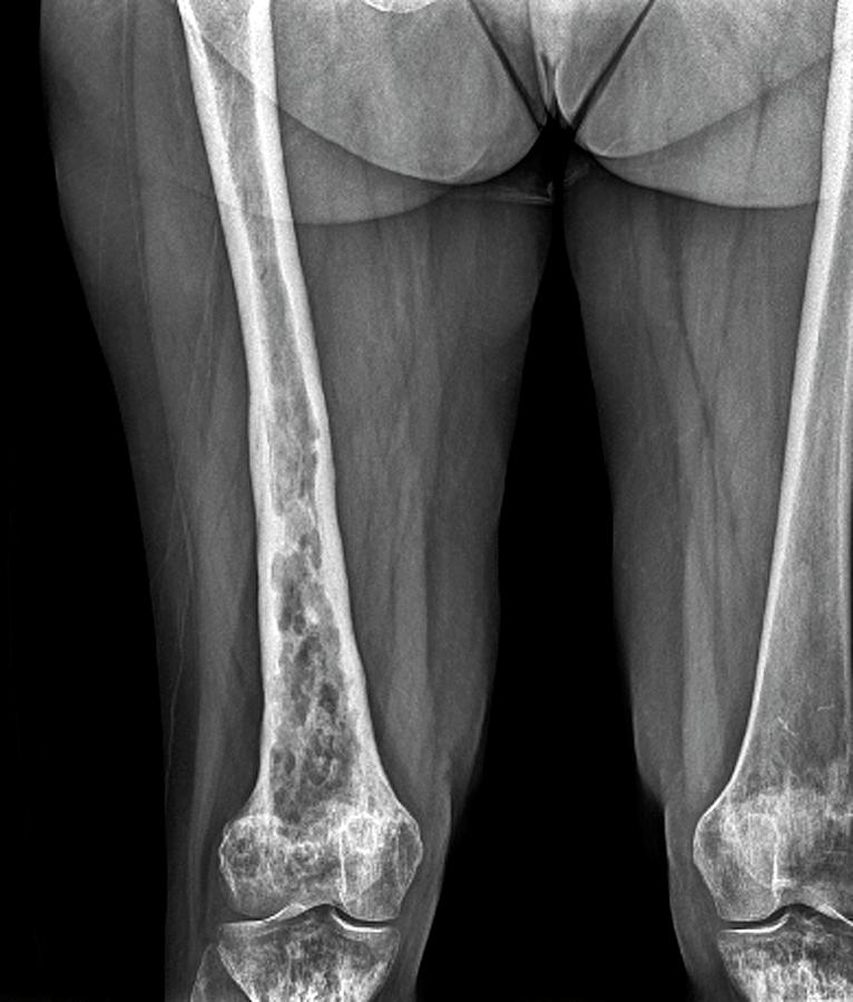 Bone Disease Photograph by Zephyr/science Photo Library