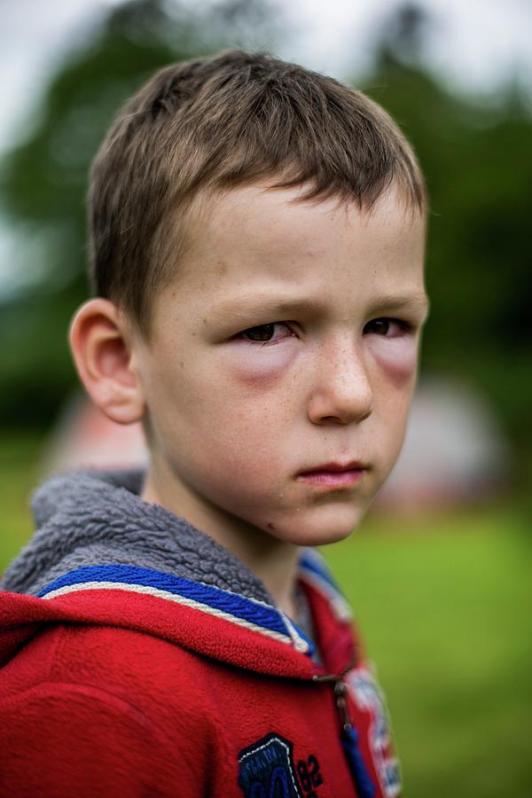 Boy With Hay Fever Allergic Reaction Photograph by Samuel Ashfield ...