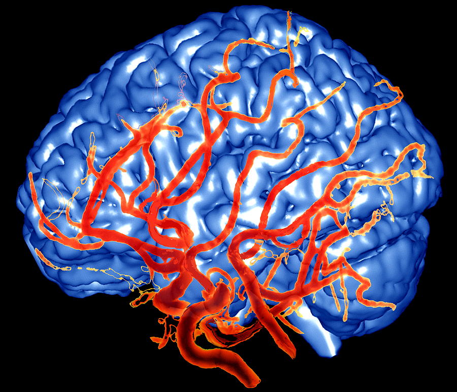 Brain And Arteries Photograph by Zephyr/science Photo Library