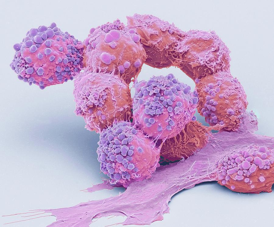 Brain Cancer Cells #1 Photograph by Steve Gschmeissner