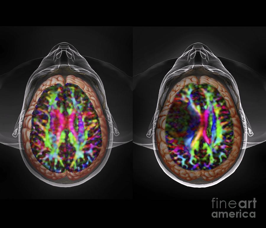 Glioblastoma Photograph - Brain Cancer, Dti And 3d Ct Scans #1 by Zephyr