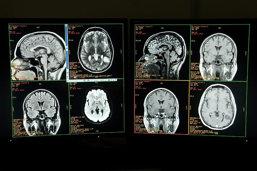 Brain Ct Scanning #1 Photograph by Mark Thomas/science Photo Library