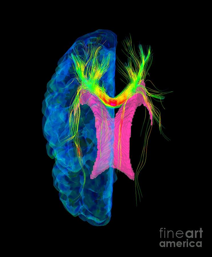 Brain Fibres, Dti Mri Scan Photograph by Sherbrooke Connectivity ...