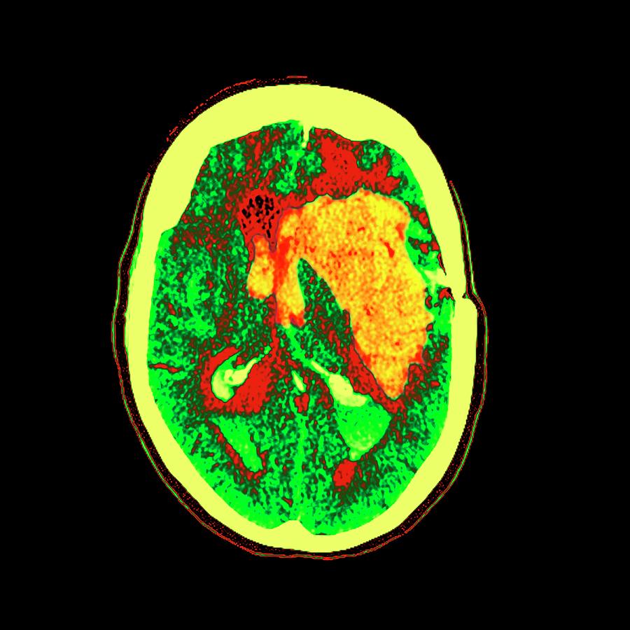 Brain Haemorrhage #1 Photograph by Science Photo Library