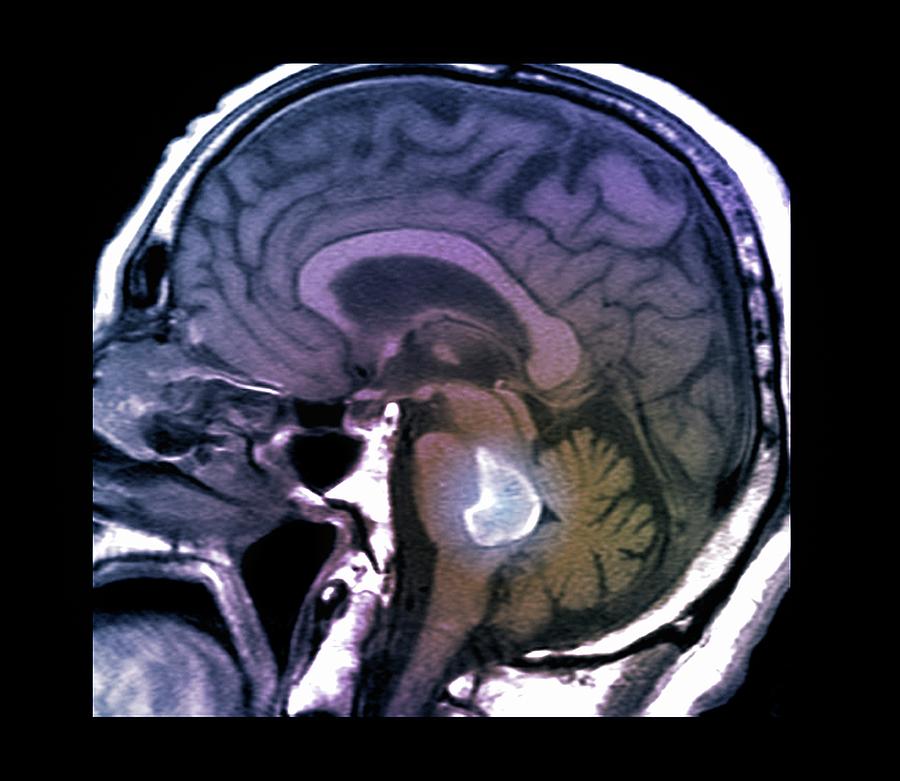 Human Photograph - Brain Haemorrhage #1 by Zephyr