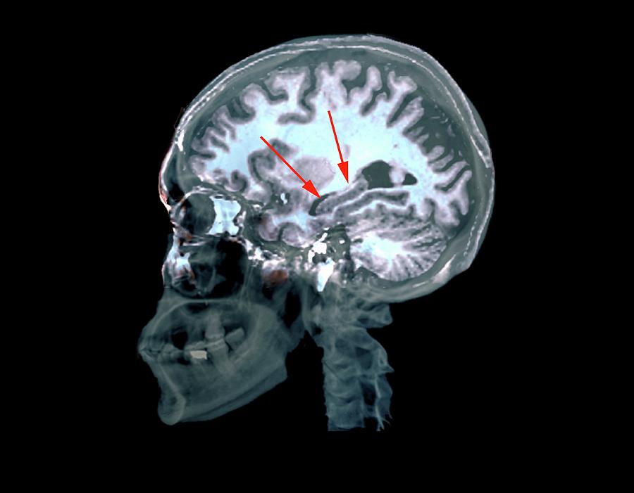 Brain In Alzheimers Disease #1 Photograph by Zephyr