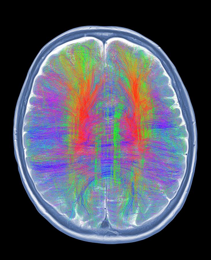 Brain Mri And White Matter Fibres #1 Photograph by Alfred Pasieka/science Photo Library