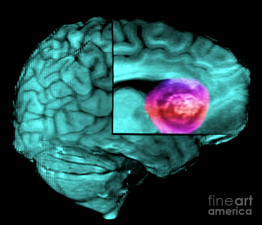 Brain Tumor, Mri #1 Photograph by Living Art Enterprises