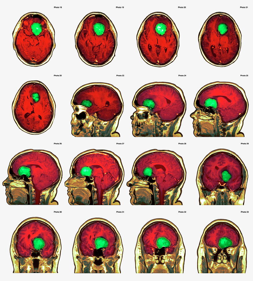 Brain Tumour Photograph By Simon Fraser/newcastle Hospitals Nhs Trust ...