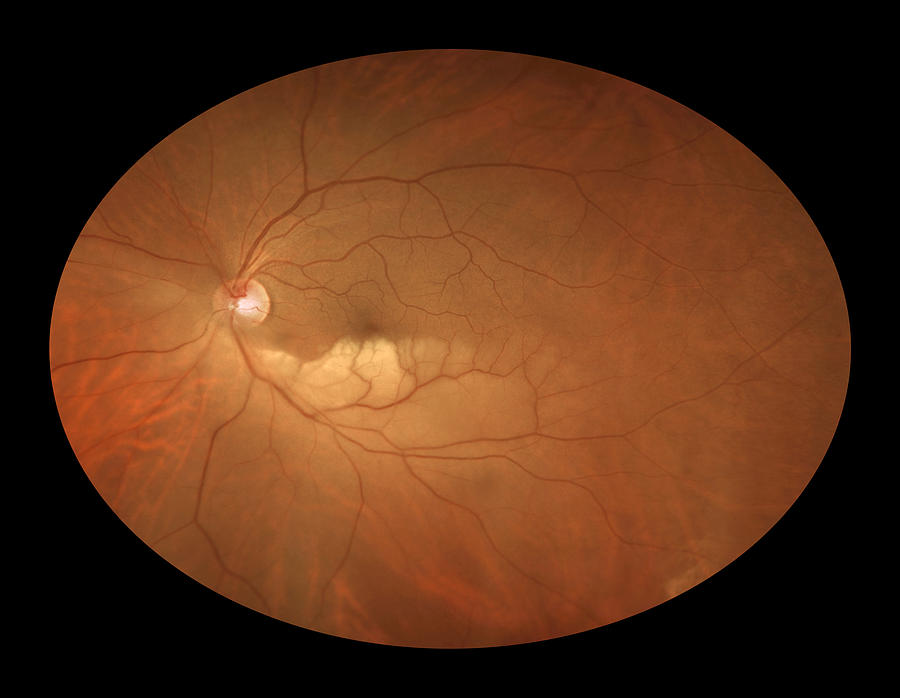 Branch Retinal Artery Occlusion Photograph by Paul Whitten - Pixels