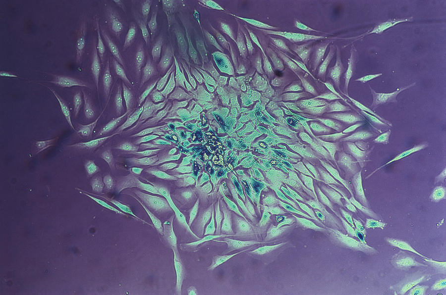 Breast Cancer Cells, Lm #2 Photograph by Dr Cecil H Fox