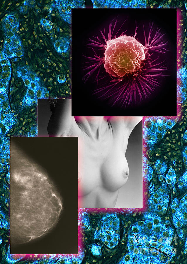 Pathology Photograph - Breast Cancer Montage #1 by Scott Camazine