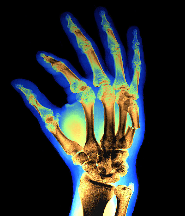 cracked bone in hand symptoms