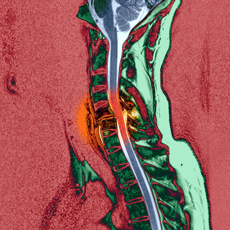 Broken Neck Photograph By Simon Fraser/newcastle Hospitals Nhs, Trust ...