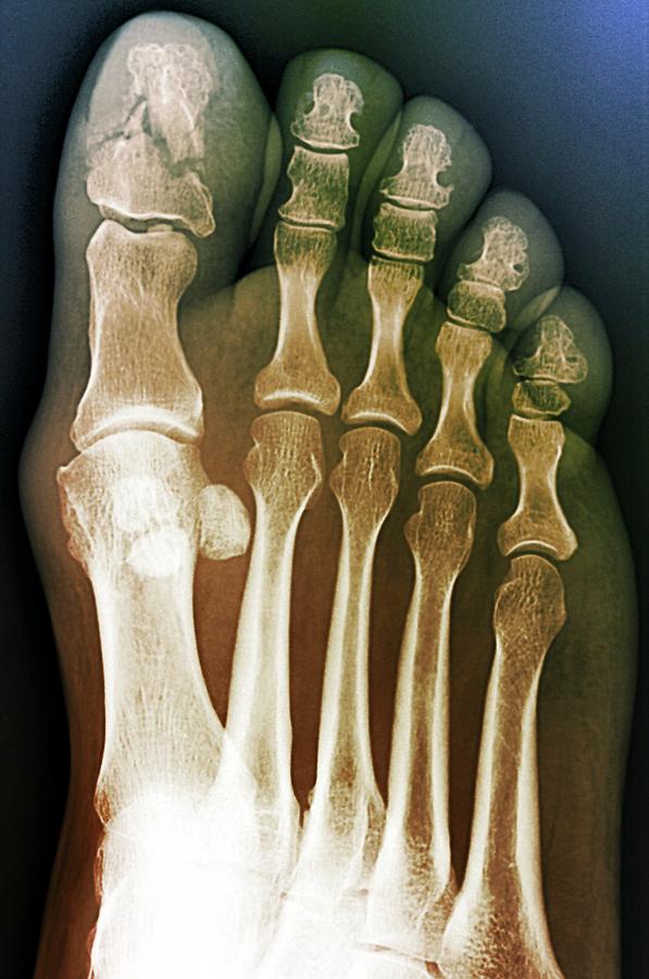 Broken Toe Bone #1 Photograph by Zephyr/science Photo Library