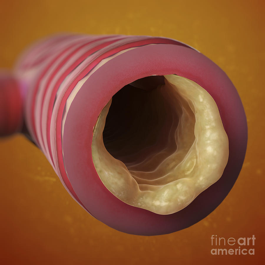 Airway Photograph - Bronchitis #1 by Science Picture Co