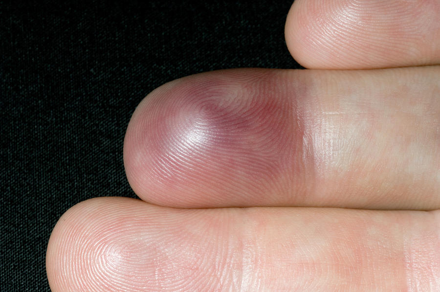 bruised-finger-photograph-by-dr-p-marazzi-science-photo-library