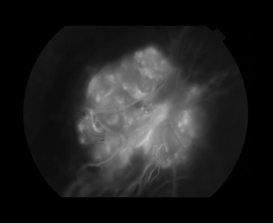 Capillary Hemangioma, Ophthalmic #1 Photograph by Paul Whitten