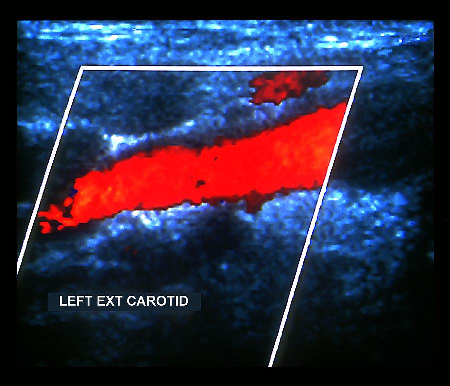 Carotid Artery #1 Photograph by Zephyr/science Photo Library