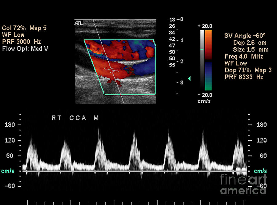 Carotid Artery Photograph - Carotid Duplex Ultrasound Exam #4 by Living Art Enterprises LLC