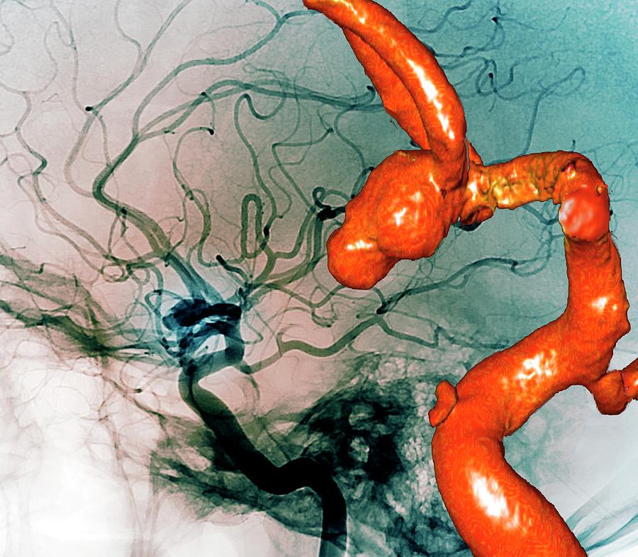 Cerebral Aneurysm #1 Photograph by Zephyr/science Photo Library