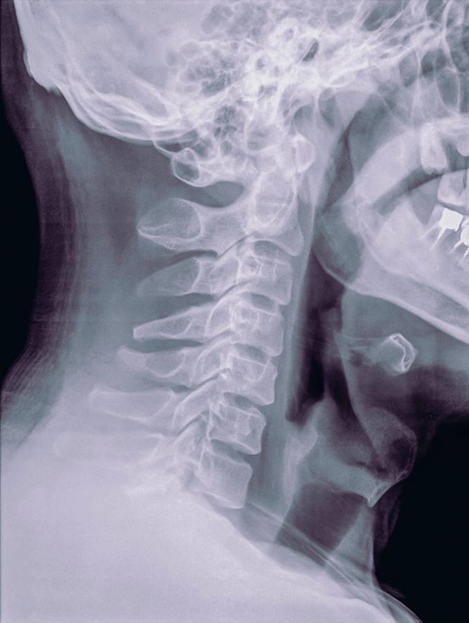 Skeleton Photograph - Cervical Spine X-ray #1 by Photostock-israel