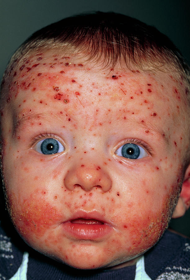 Chickenpox And Eczema On The Face Of A Baby Boy By Dr P Marazziscience Photo Library