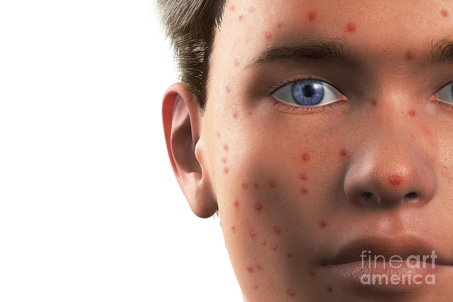 Chickenpox Blisters #1 Photograph by Science Picture Co