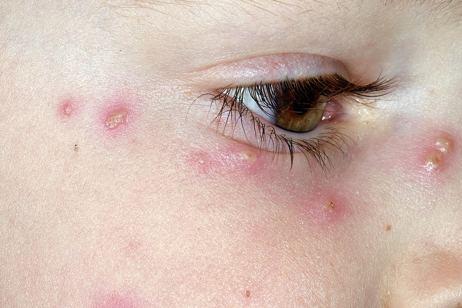 Chickenpox Rash Photograph by Dr P. Marazzi/science Photo Library