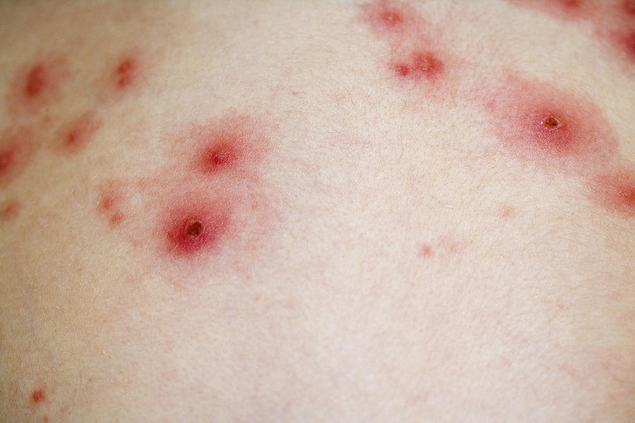 Chickenpox Rash #1 Photograph by Science Stock Photography
