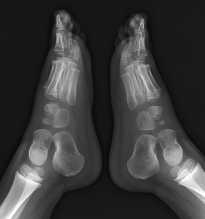 Childhood Bone Development Photograph by Zephyr/science Photo Library ... Biology Diagrams