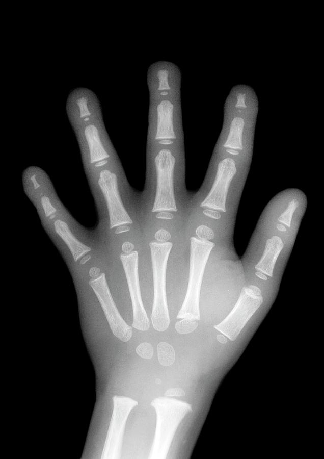 Childs Hand #1 Photograph by Aj Photo/science Photo Library
