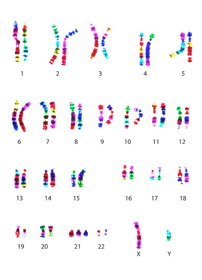 Anomaly Photograph - Chromosomes In Downs Syndrome #1 by L. Willatt, East Anglian Regional Genetics Service/science Photo Library