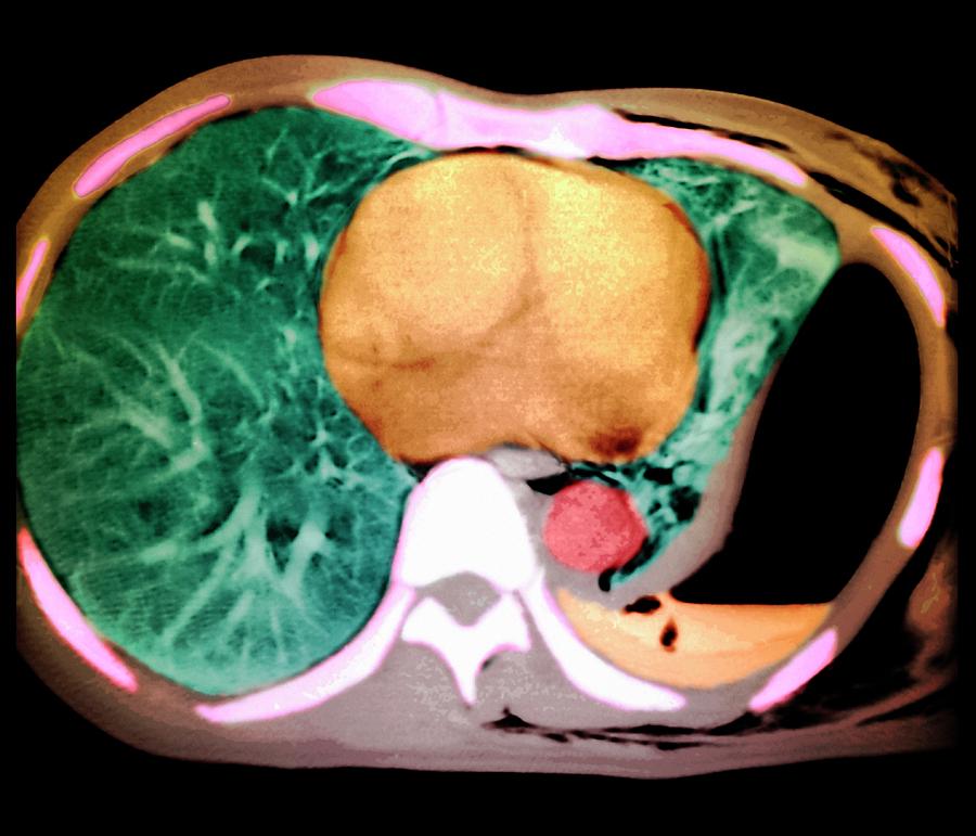 collapsed-lung-photograph-by-zephyr-science-photo-library