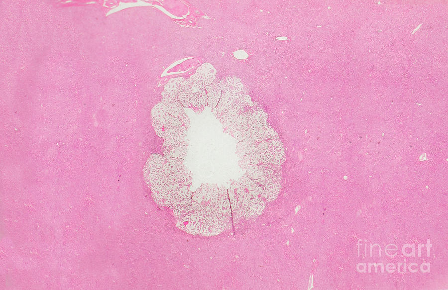 Colloid Liver Tumor, Lm #1 Photograph by Garry DeLong