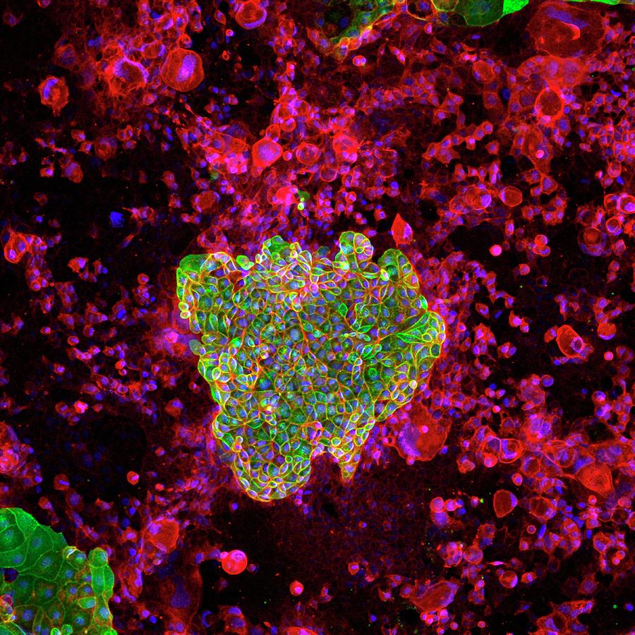 Colon Cancer Photograph - Colon Cancer Cells #1 by Ammrf, University Of Sydney