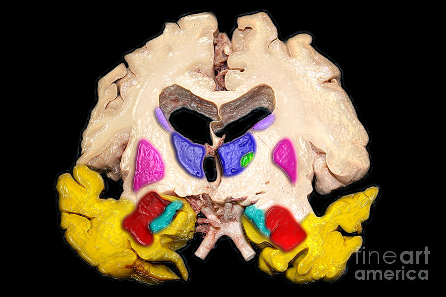 Color Enhanced Severe Alzheimers Disease #1 Photograph by Living Art Enterprises