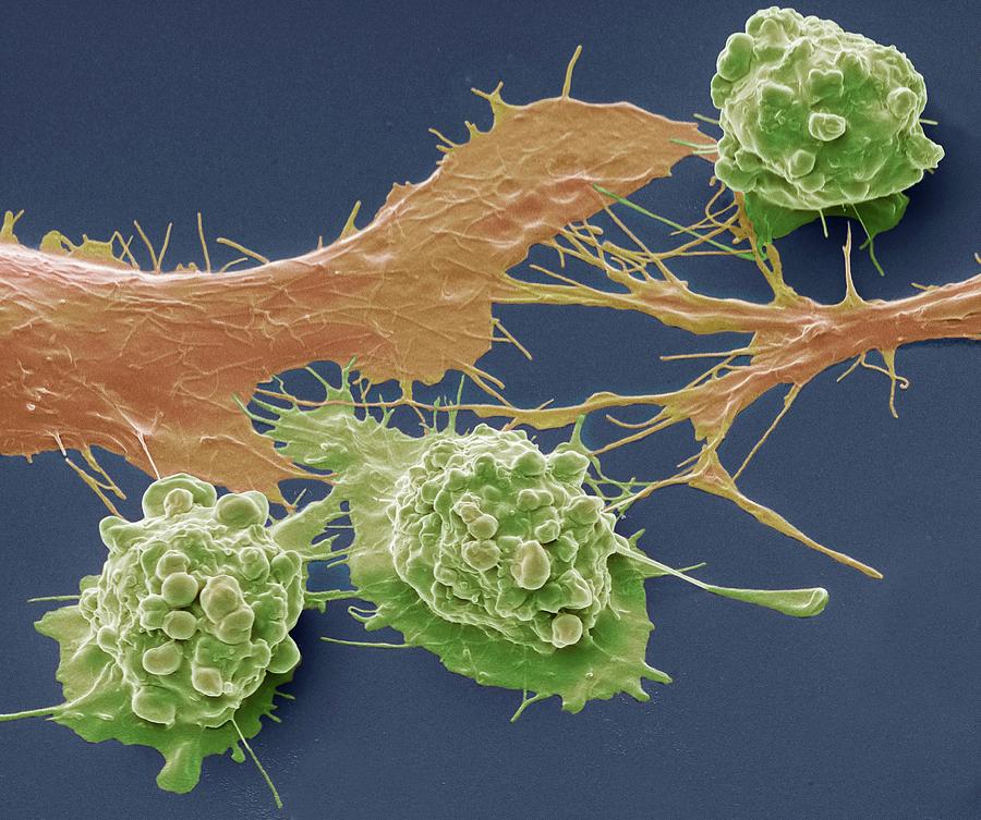 Colorectal Cancer Cells Photograph by Steve Gschmeissner - Pixels