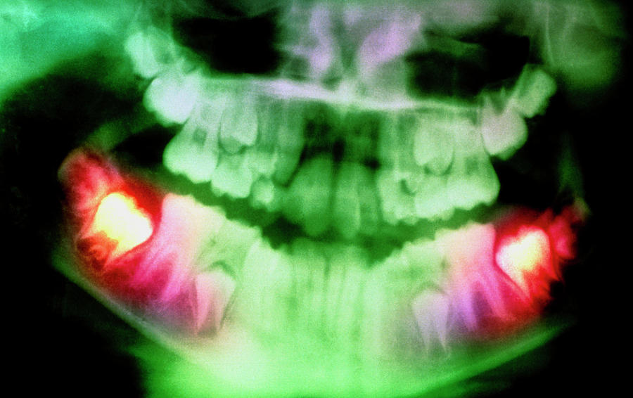 Colour Pan-oral X-ray Of Erupting Molars In Child #1 Photograph by Science Photo Library