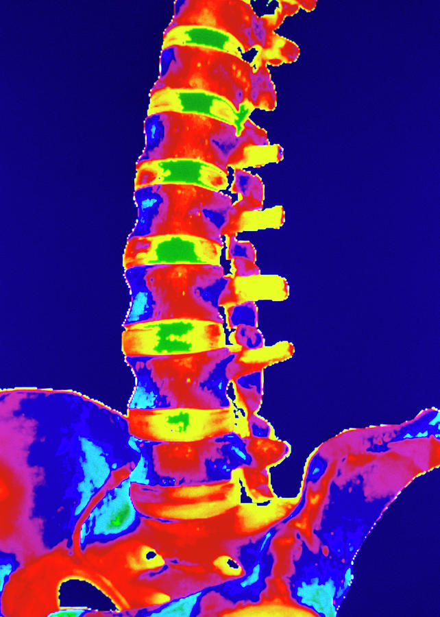 Coloured 3-d Ct Scan Of Lower Spine #1 Photograph by Gjlp/science Photo Library