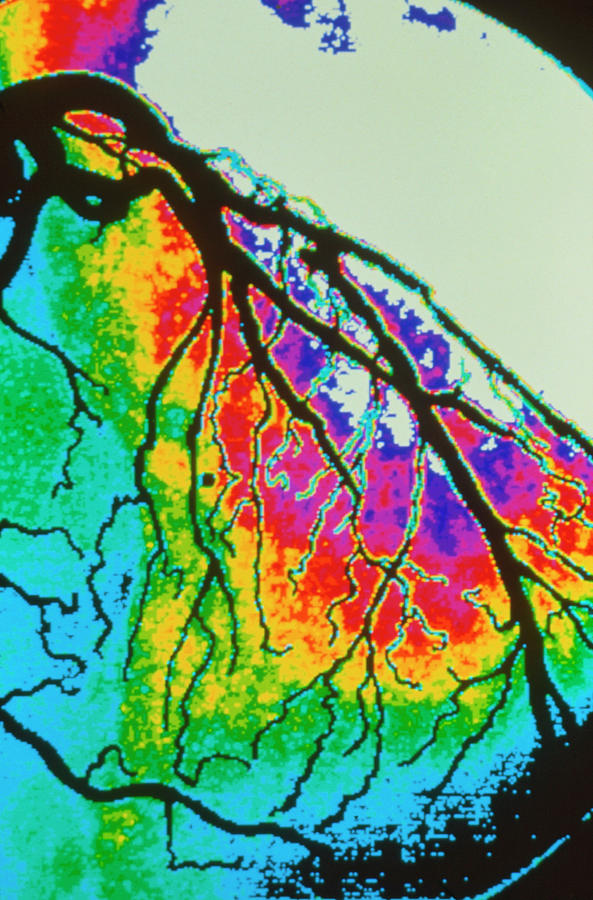 Coloured Angiogram Of Coronary Artery Of The Heart #1 Photograph by Gca/science Photo Library